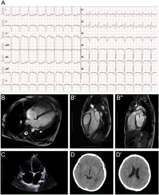 A rare homozygous variant of CHKB induced severe cardiomyopathy and a cardiac conduction disorder: a case report